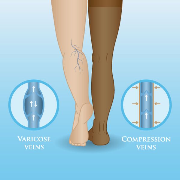 Compression knitwear and underwear for varicose veins how to choose
